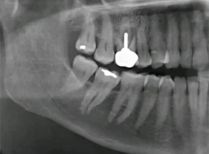 Debridement and Antibacterial Protocols in Immediate Implant Placement tandimplantat Malmö